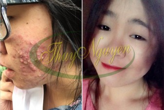 Liệu Trình Điều Trị Mụn Cho Khách TN131016 - Mụn Mũ - Mụn Bọc - Nhiễm Khuẫn Do Mỹ Phẩm